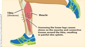 درد ساق پا - Shin Splints 