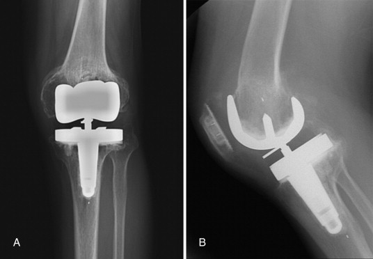 استئولیز Periprosthetic