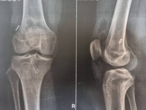 جراحی بازسازی رباط صلیبی