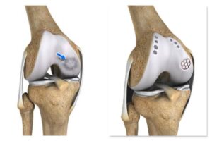 جراحی پیوند غضروف و استخوان- autogenous osteochondral transfer 