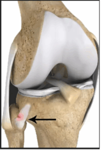 Proximal Tibiofibular Ligament Instability