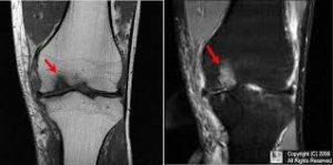 استئوکندریت دیسکان زانو - نمای MRI