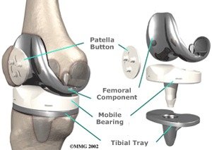 اجزای ایمپلنت زانو 