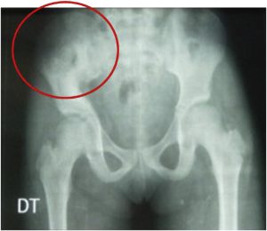 استئولیز (osteolysis)