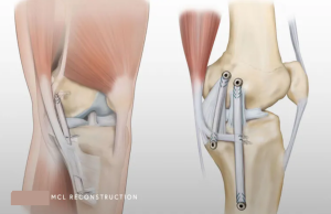 جراحی بازسازی رباط جانبی داخلی