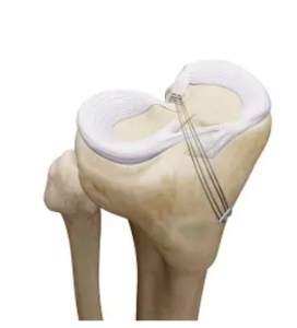 پارگی ریشه منیسک