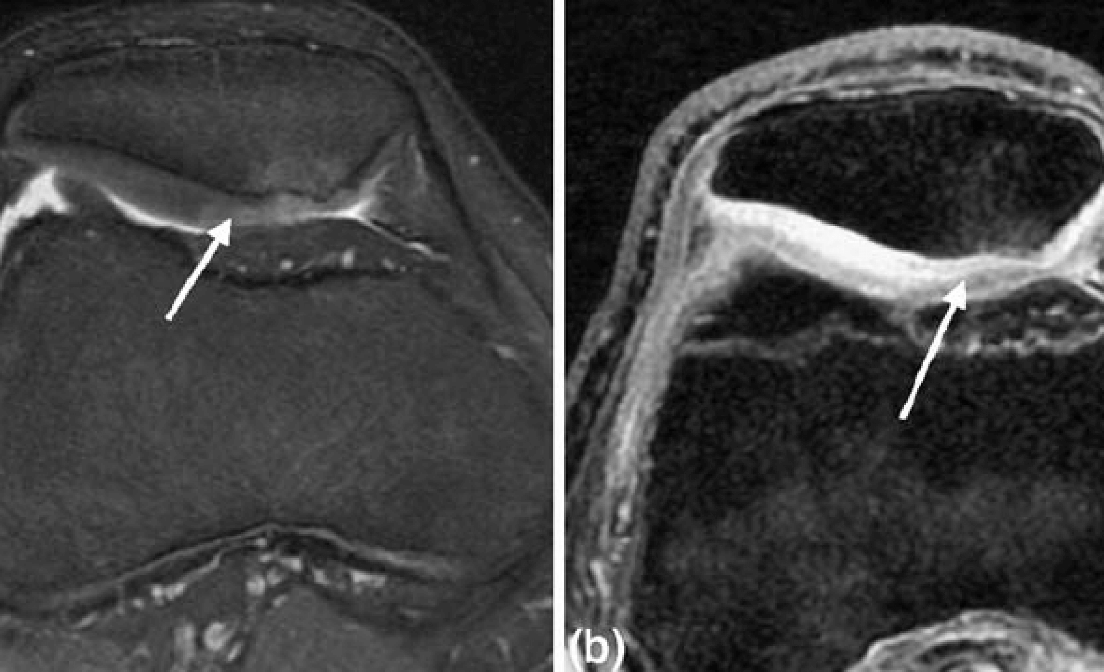 نمای MRI نرمی غضروف کشکک زانو