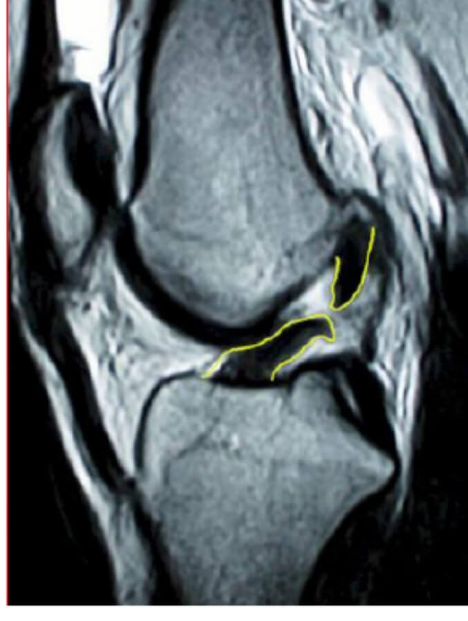 نمای ACL پاره شده در MRI