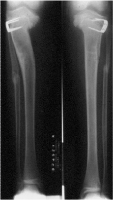 Xray-epiphysiodesis
