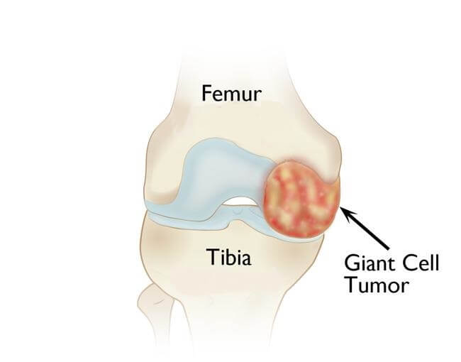 تومورهای زانو : تومور با سلول غول آسا 