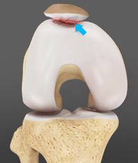 نرمی غضروف کشکک زانو - chondromalacia patella