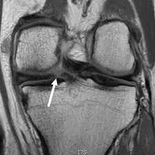 پارگی ریشه منیسک - نمای MRI