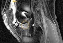 Arthrofibrosis پس از جراحی بازسازی رباط صلیبی قدامی