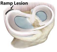 Ramp lesion meniscus