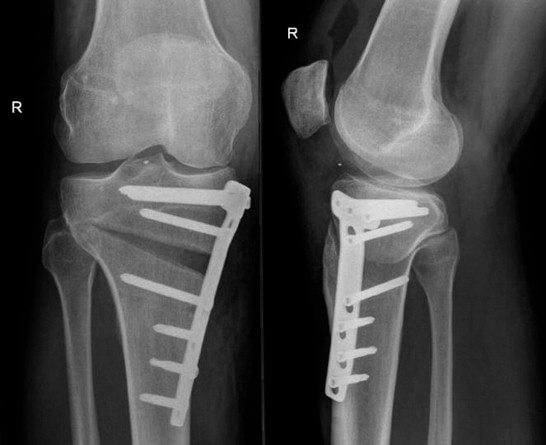 open wedge high tibial osteotomy