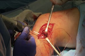 جراحی بازسازی LCL