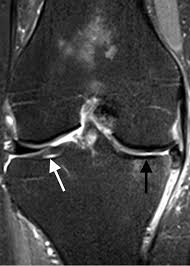 تخریب غضروف مفصل زانو- MRI