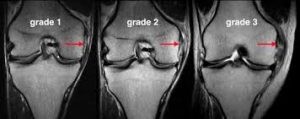 درجات پارگی MCL - نمای MRI 