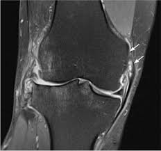 پارگی MCL- نمای MRI