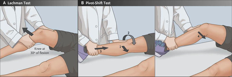 تستهای مختلف ارزیابی لیگامانها و منیسک ها 