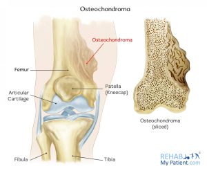استئوکندروم- osteochondroma